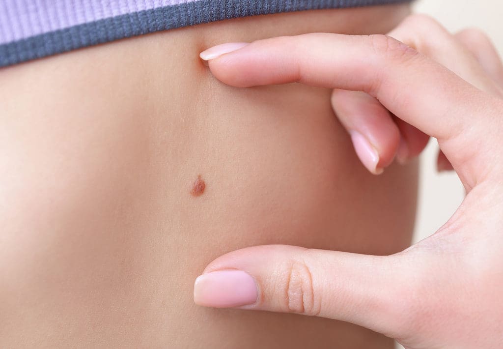 A close-up of a small mole on the skin being checked between two fingers.